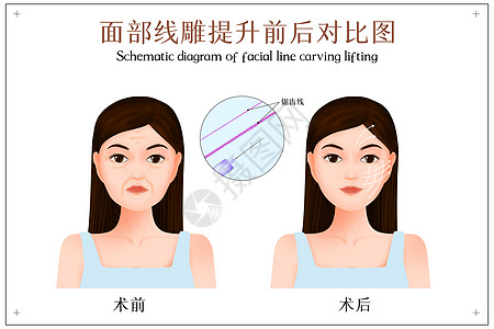 整形对比面部线雕提拉手术前后对比示意图插画