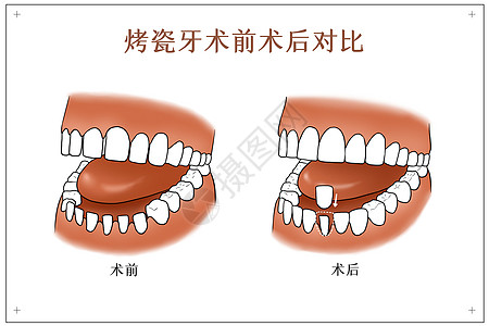 牙齿对比烤瓷牙术前术后对比口腔医学配图插画