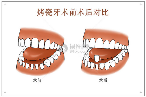 烤瓷牙术前术后对比口腔医学配图图片