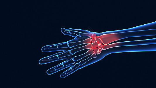 腕管症3D职业病腱鞘炎场景设计图片