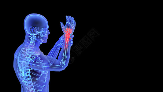 3D手腕疾病图片