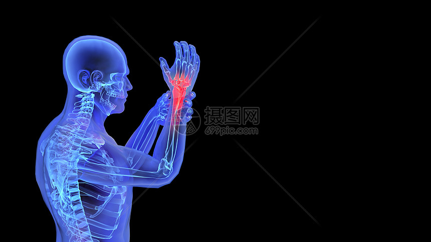 3D手腕疾病图片