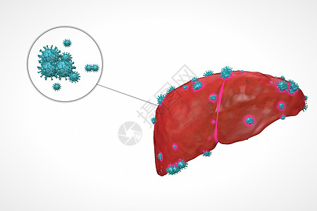 肝部乙肝病变设计图片