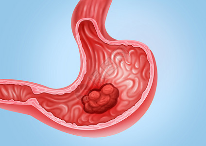 人体模型胃癌医疗健康插图插画