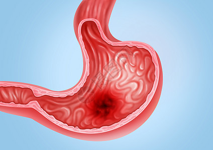 胃溃疡医疗健康插图图片