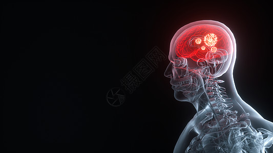 脑CT片3D脑癌场景设计图片