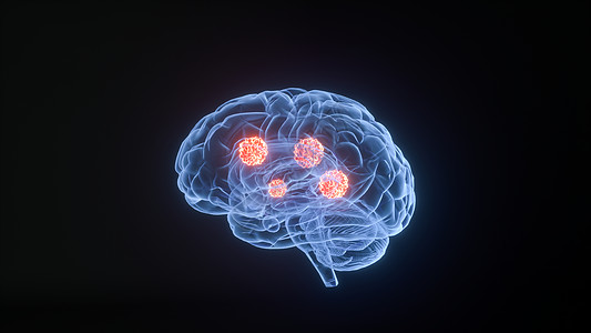肿瘤转移3D疾病脑癌场景设计图片