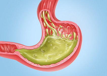 胃反流医疗健康插图图片