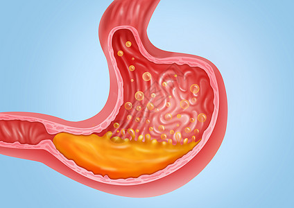 胃胀医疗健康插图图片