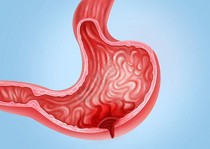 胃穿孔医疗健康插图图片