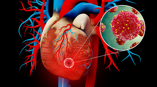 心梗阻人体心脏疾病场景设计图片