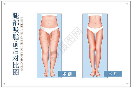 大腿吸脂前手术前后对比示意图背景图片
