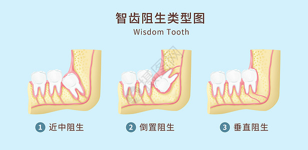 智齿阻生类型图医疗插图图片