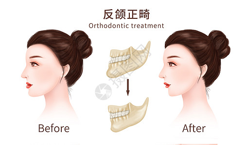 正畸反颌牙齿矫正医疗插图插画