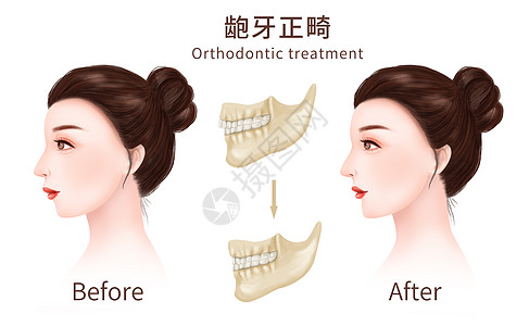 正畸龅牙牙齿矫正医疗插图插画