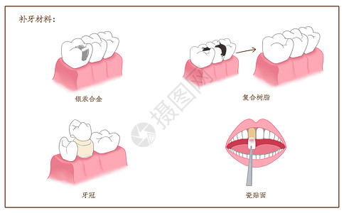 补牙材料口腔医学配图高清图片