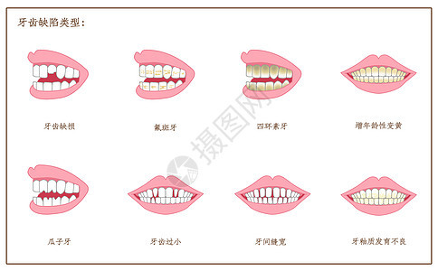 牙齿缺陷口腔医学配图图片