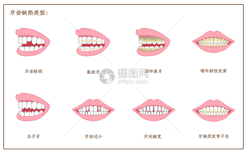 牙齿缺陷口腔医学配图图片