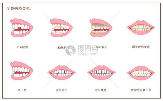 牙齿缺陷口腔医学配图图片