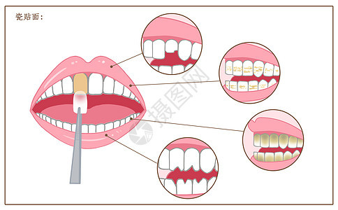 牙齿瓷贴面修复口腔医学配图背景图片