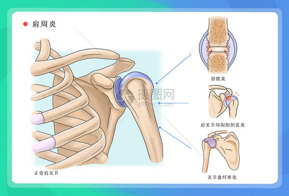 肩周炎医疗插图高清图库