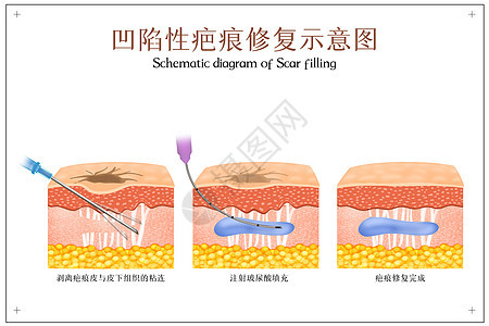 凹陷性疤痕修复示意图背景图片