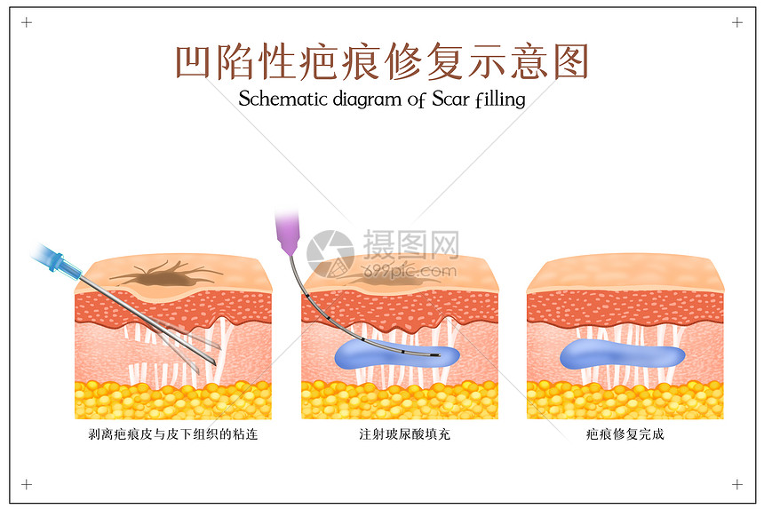 凹陷性疤痕修复示意图图片