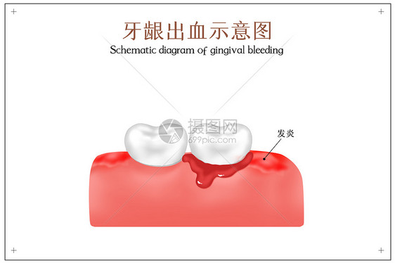 牙龈出血示意图图片