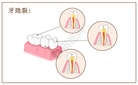 裂纹效果牙齿隐裂口腔医学配图插画
