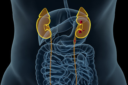 肾结石病变场景图片
