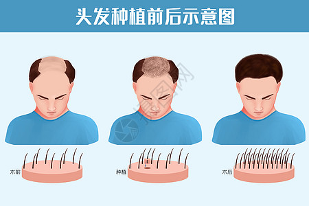 微创手术头发种植前后对比图插画