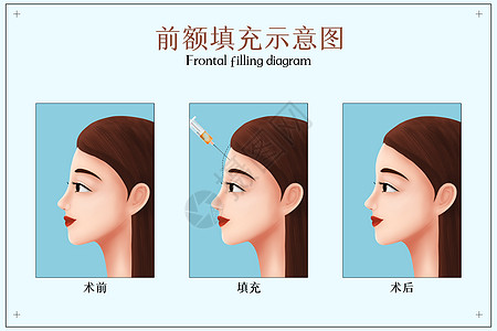 前额扁塌填充手术医疗配图背景图片