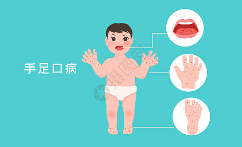 儿童手足口病图片