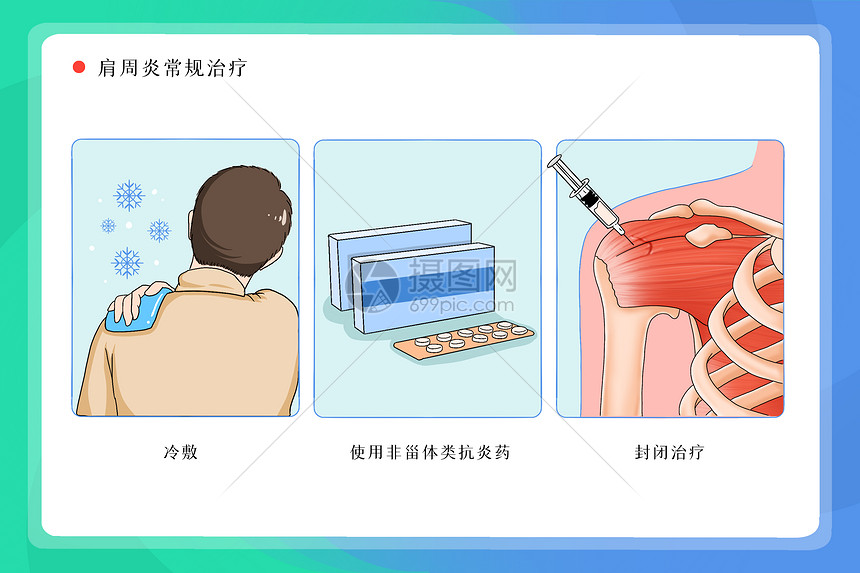 肩周炎常规治疗医疗插画图片