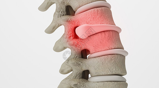 腰椎间盘突出场景图片
