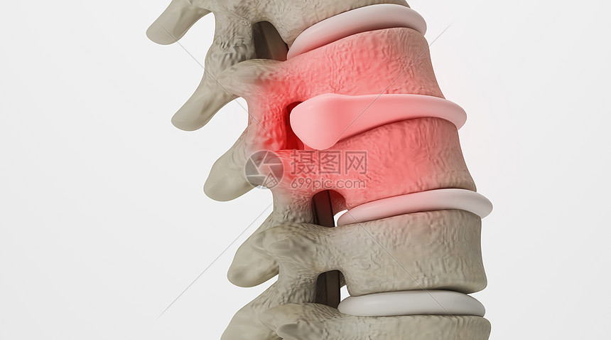 腰椎间盘突出场景图片