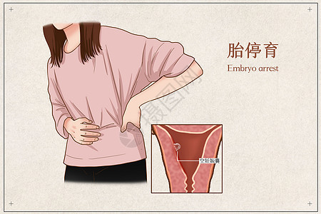 胎停育医疗插画背景图片