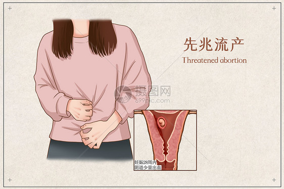 先兆流产医疗插画图片