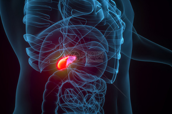 胆囊炎场景图片