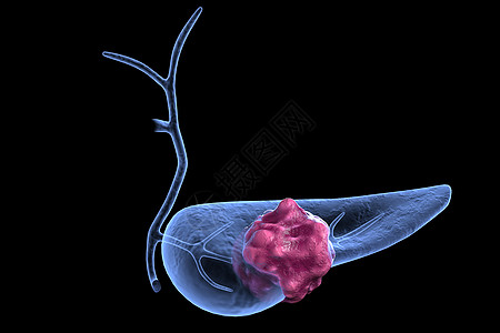 胰腺肿瘤模型图片