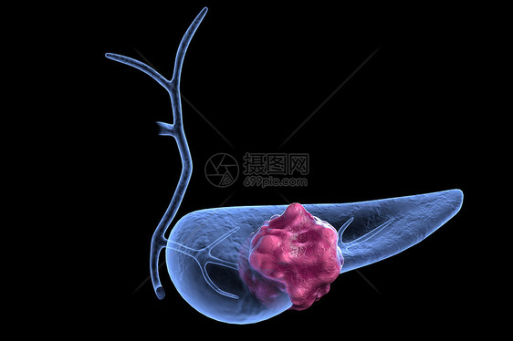 胰腺肿瘤模型图片
