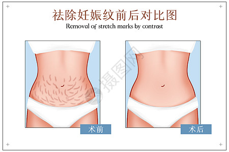 揉肚子妊娠纹祛除手术前后对比图插画