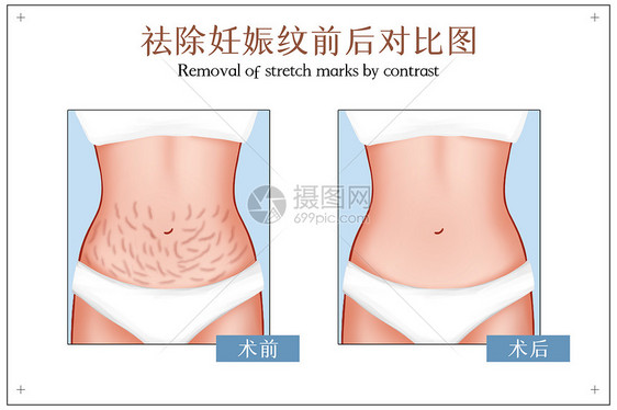 妊娠纹祛除手术前后对比图图片