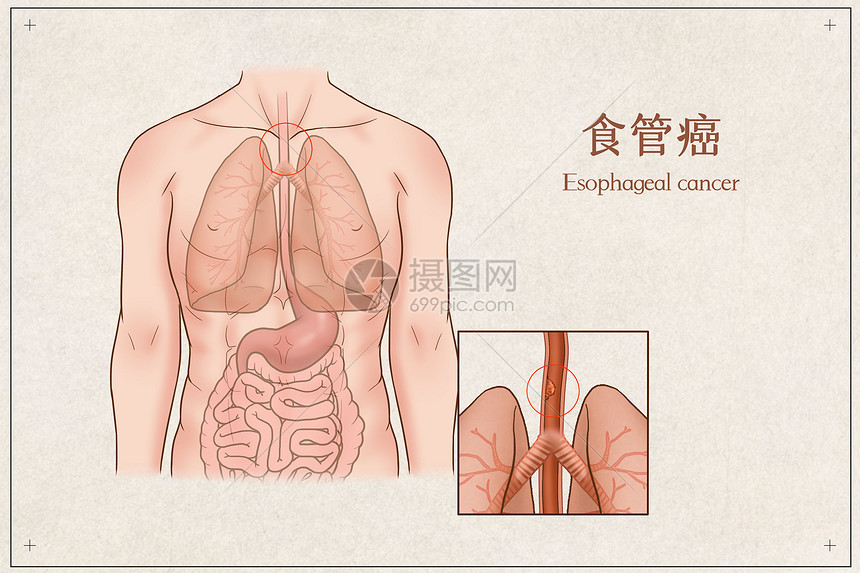 食管癌医疗插画图片