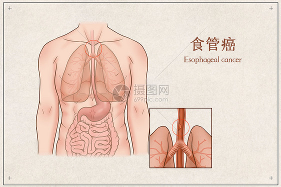 食管癌医疗插画图片