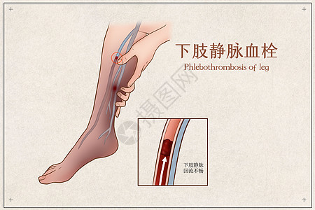 下肢静脉血栓医疗插画高清图片