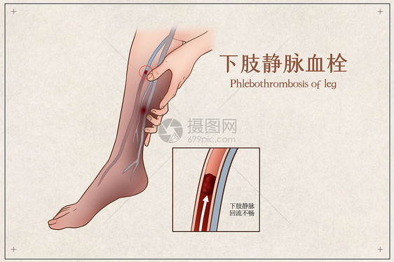 下肢静脉血栓医疗插画图片