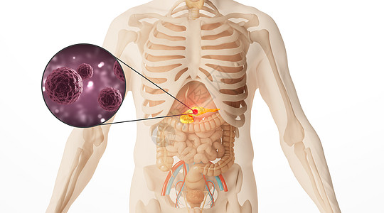 脏器人体胰腺癌场景设计图片