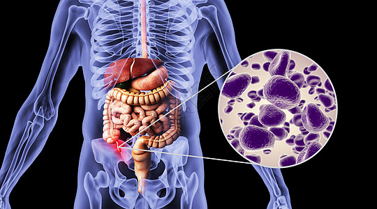 人体阑尾炎场景图片