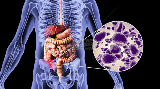 人体阑尾炎场景图片